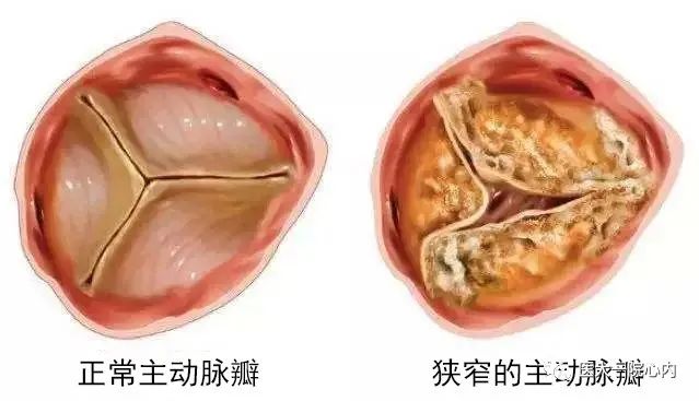 蓝帆医疗：新一代可回收经导管主动脉瓣置换术输送系统获得CE证书